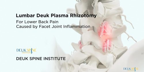 lumbar Deuk plasma rhizotomy for back pain with an image of a spine highlighting inflamed facet joints.