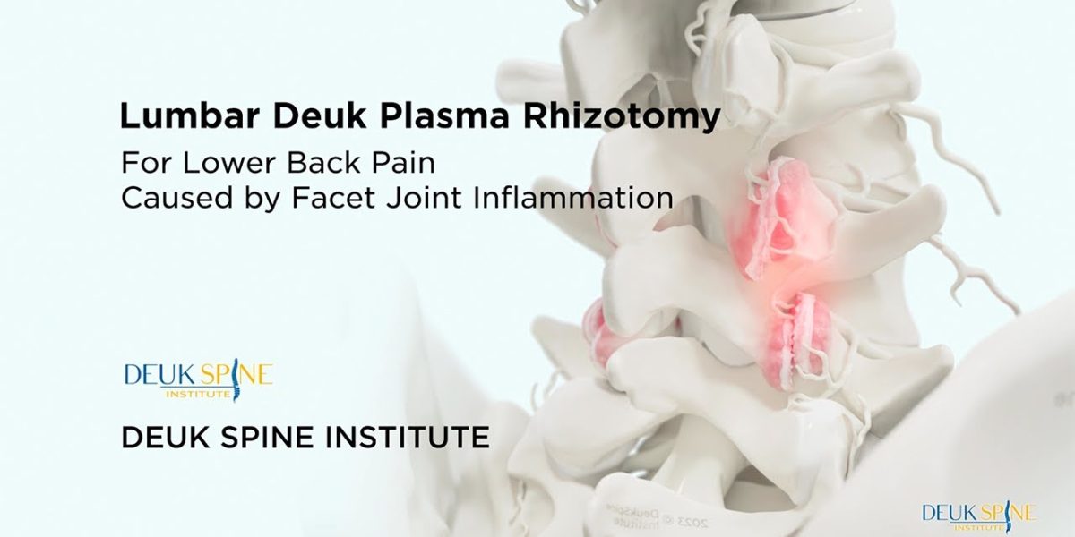 lumbar Deuk plasma rhizotomy for back pain with an image of a spine highlighting inflamed facet joints.