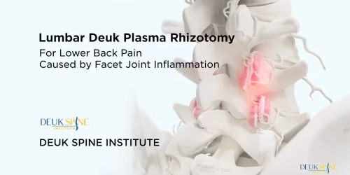 lumbar Deuk plasma rhizotomy for back pain with an image of a spine highlighting inflamed facet joints.