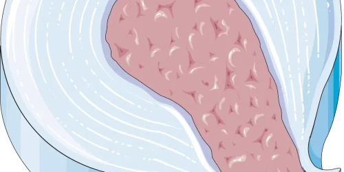 Illustration of a disc extrusion in the spine, showing protruding inner material.