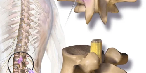 Medical illustration of facet syndrome in the spine