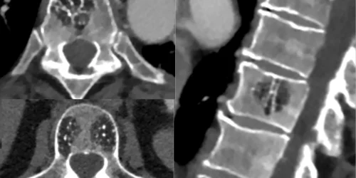 CT scans showcasing Hemangioma Spine
