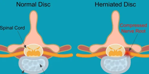 A picture showcasing a comparison between a normal disc and a herniated disc.