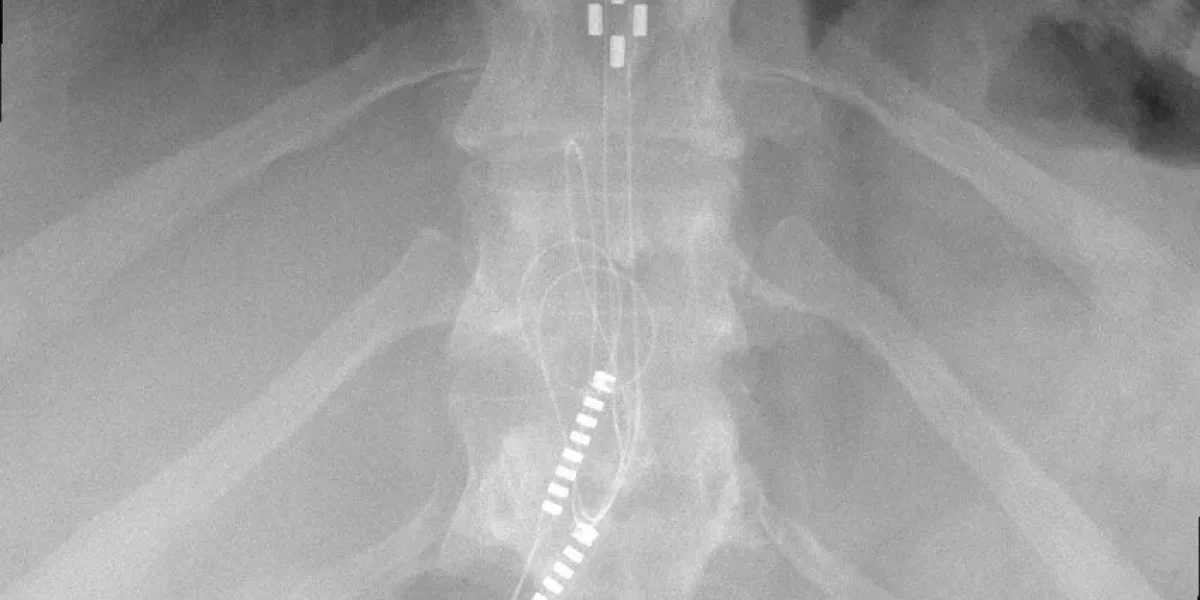 An x-ray showcasing the spinal cord stimulator.