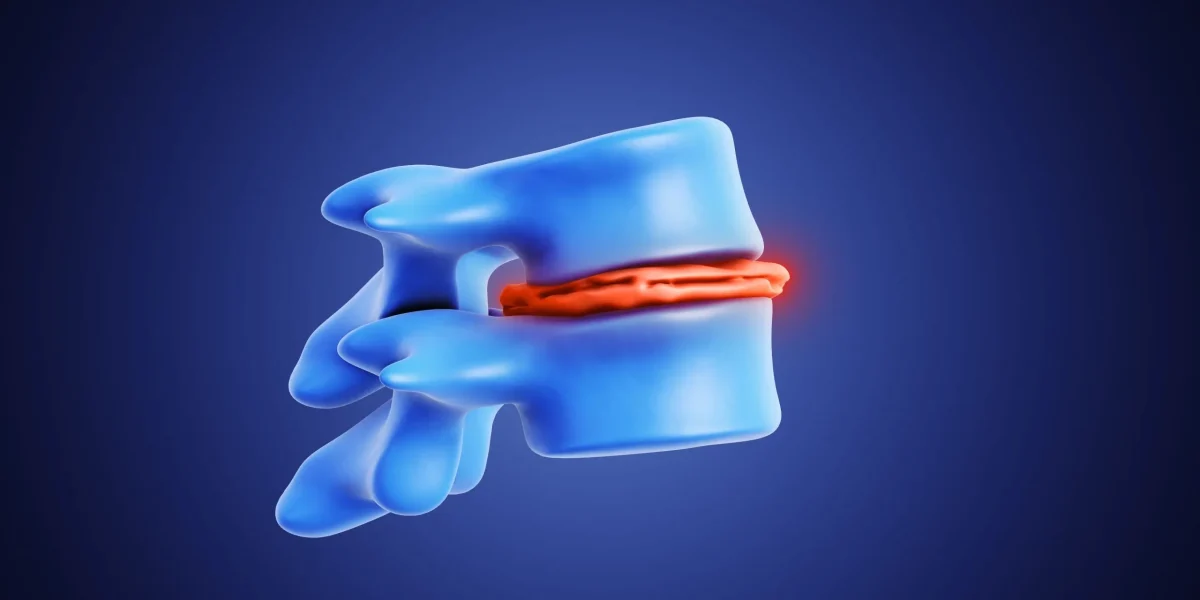 Illustration of a C7-T1 disc bulge showing spinal pressure and inflammation.