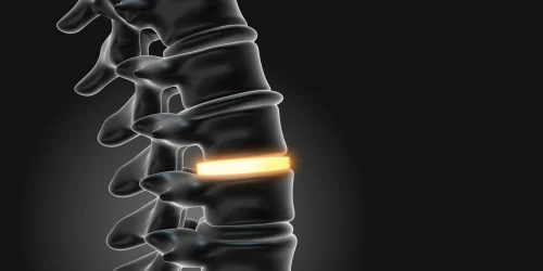 3D model showing a glowing spine disc illustrating Intervertebral Disc Disease.