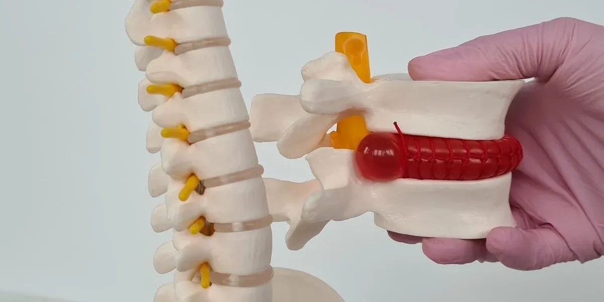 Disc Protrusion — Back Surgery Diagnosis and Prevention A model of a human spine with a gloved hand holding a vertebra segment showing a red herniated disc.