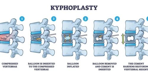 Illustration of kyphoplasty, a spinal fracture treatment through steps 1-5.