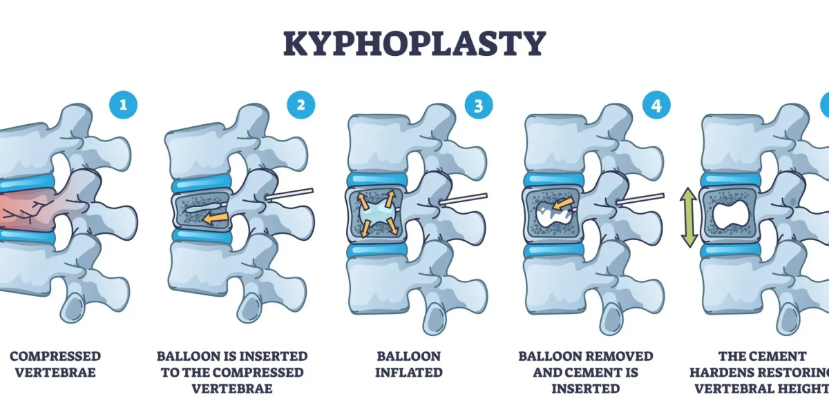 Illustration of kyphoplasty, a spinal fracture treatment through steps 1-5.