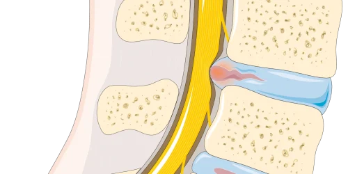 Diagram showing L3-L4 disc herniation pressing on spinal nerve.