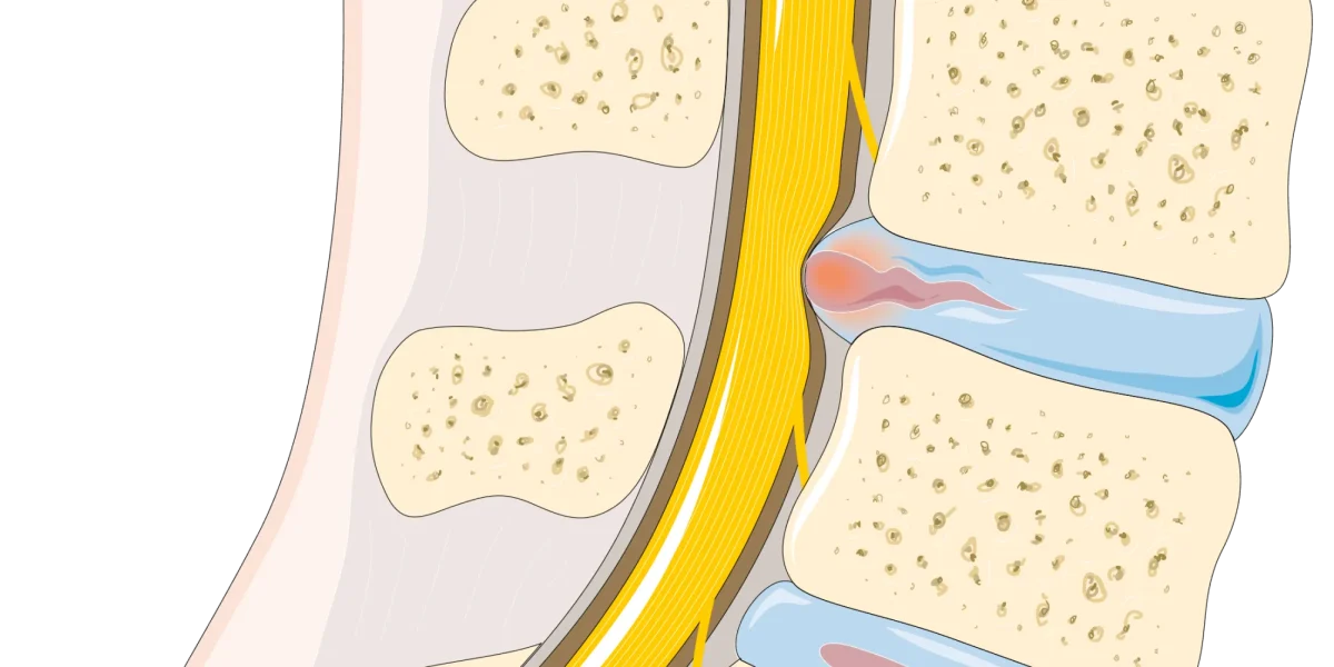 Diagram showing L3-L4 disc herniation pressing on spinal nerve.