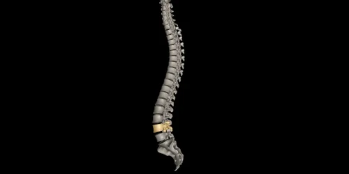 3D image of a human spine highlighting the L4-L5 disc herniation.