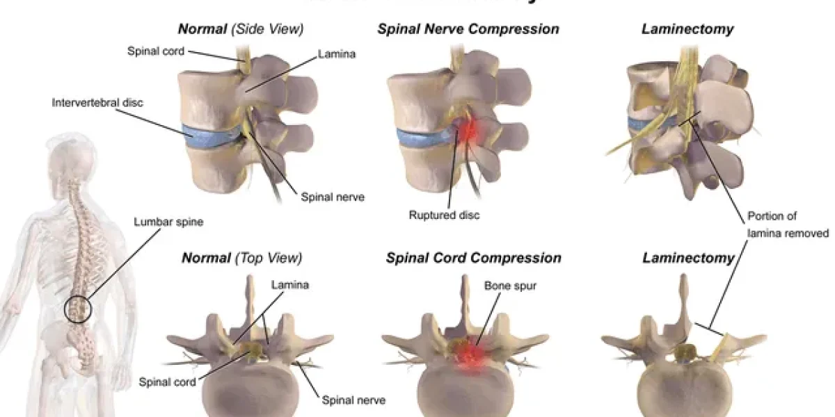 Diagram demonstrating before and after laminectomy procedure.