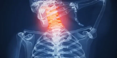 X-ray image showing a herniated disc at C4-C5 in the neck, highlighted in red.