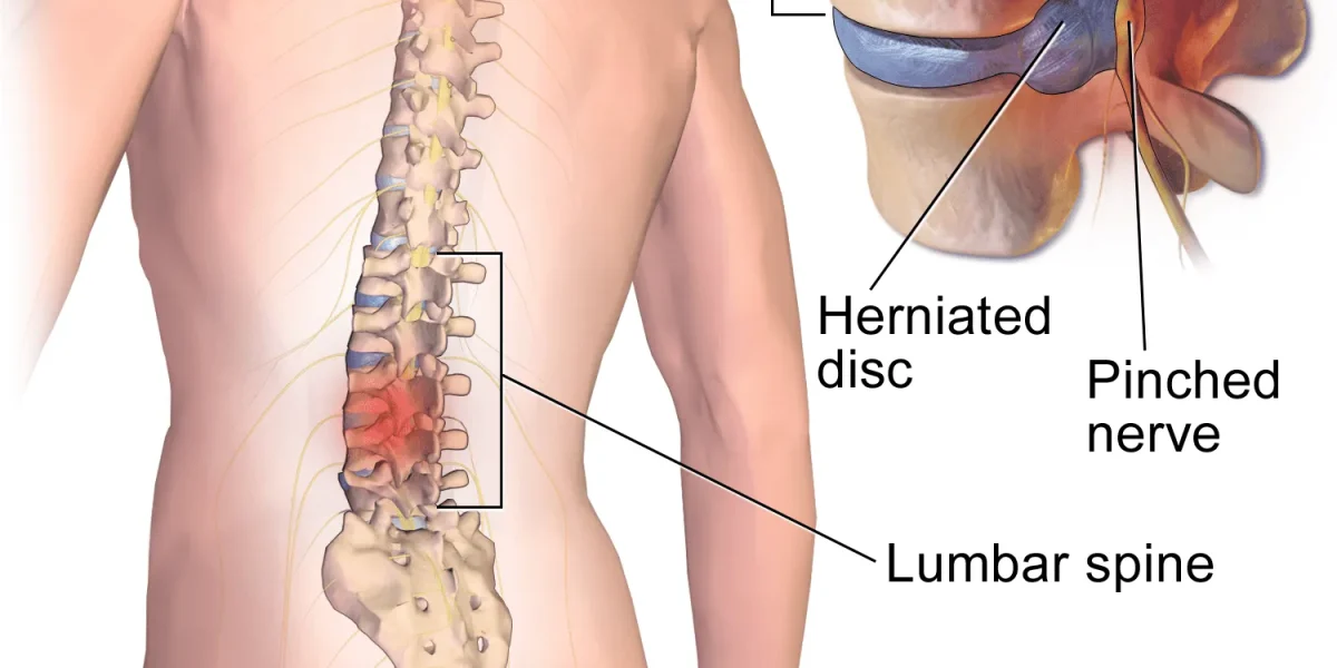 Diagram of a lower back showing a pinched nerve due to herniated disc.