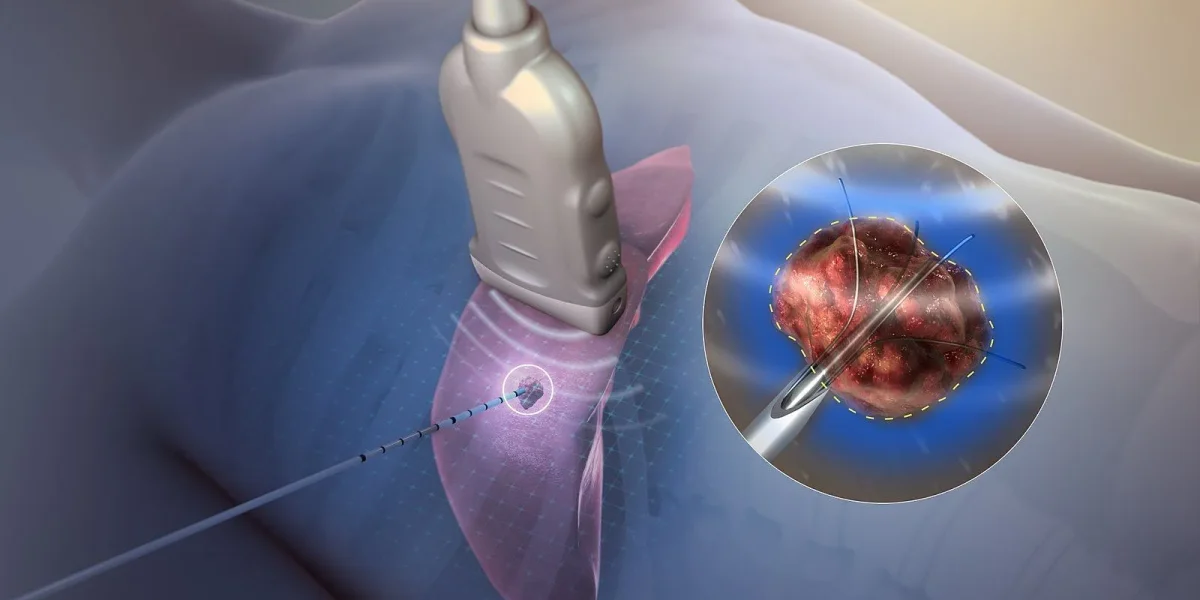 Illustration of a medical device targeting a tumor for pain management therapy.