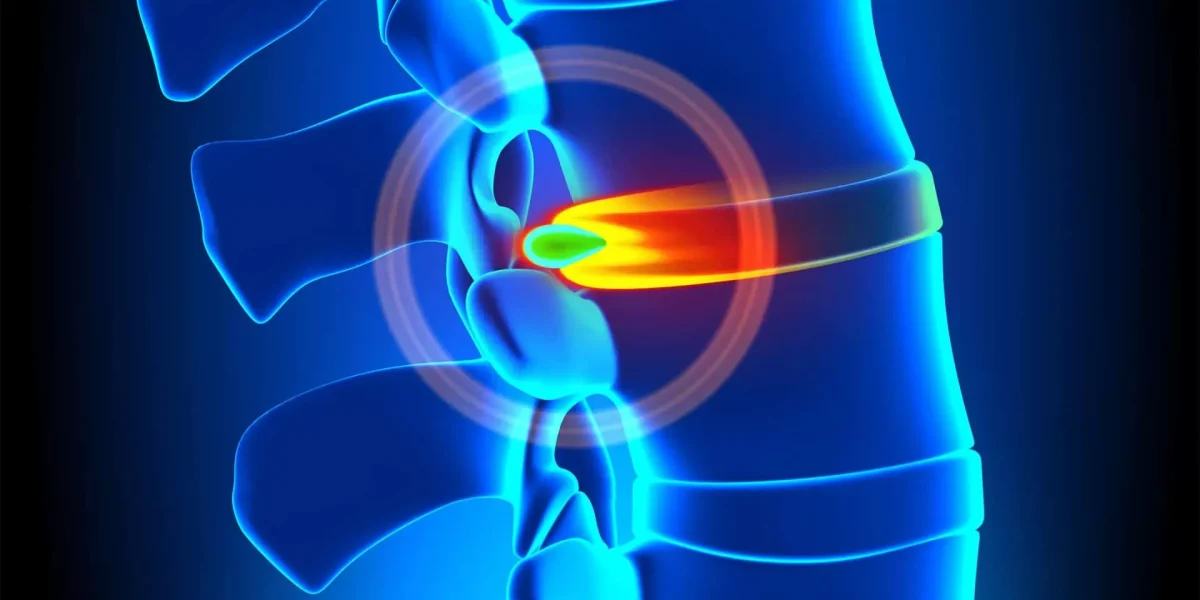 Digital illustration of a human spine with a highlighted ruptured disc in orange.