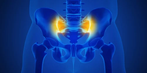 Illustration highlighting sacroiliitis