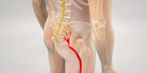 Illustration of human spine and sciatic nerve highlighting areas affecting sciatica