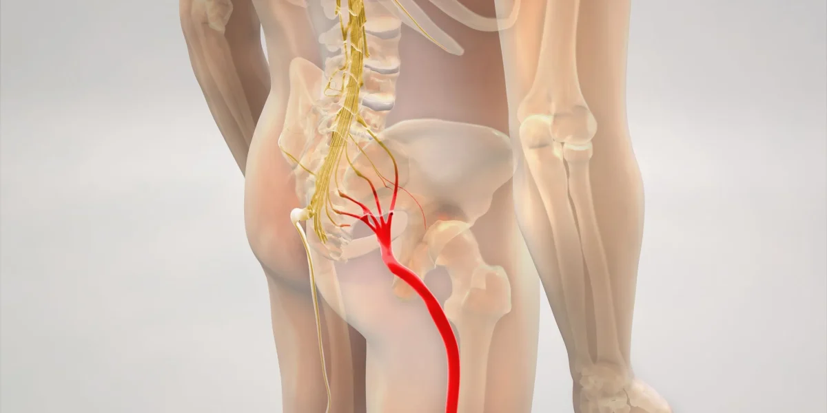 Illustration of human spine and sciatic nerve highlighting areas affecting sciatica