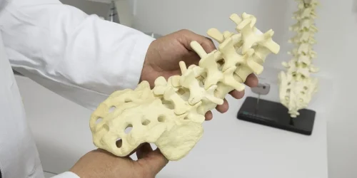 Illustrations of spinal stenosis in side and top views