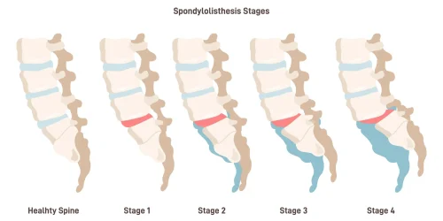 Diagram showing five stages of spondylolisthesis from healthy to stage 4.