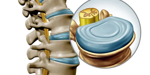 thoracic herniated disc