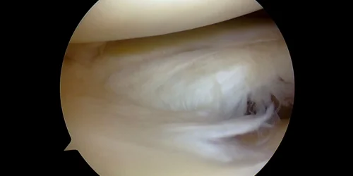 Endoscopic view of a torn disc.